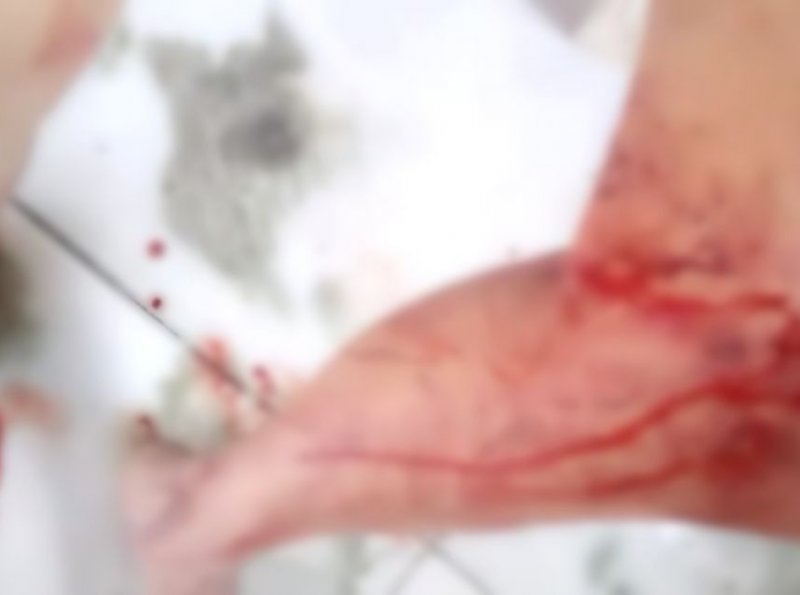 Homem cai sobre faca durante discussão e é socorrido pelo SAMU